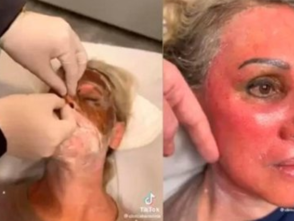 Mulher é encontrada morta e desfigurada após comprar peeling de fenol pela internet