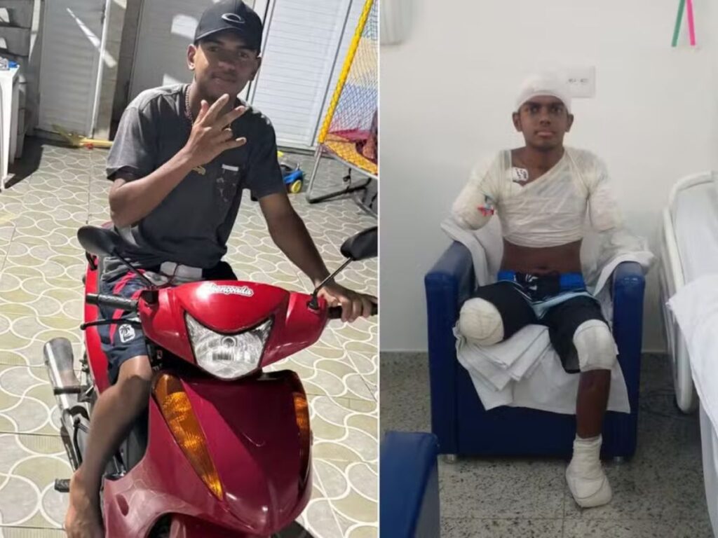 Adolescente perde braços, perna e pé após ser eletrocutado para proteger pai
