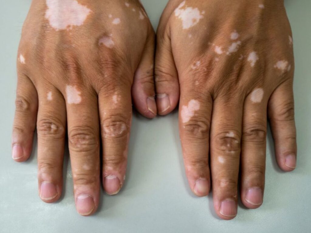 Homem com 98% do corpo com vitiligo termina o relacionamento e manchas somem