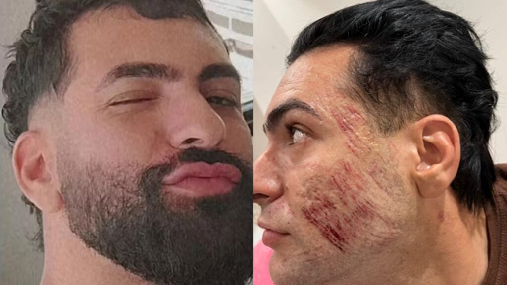 Peeling de fenol: veja os riscos do procedimento que matou jovem de 27 anos