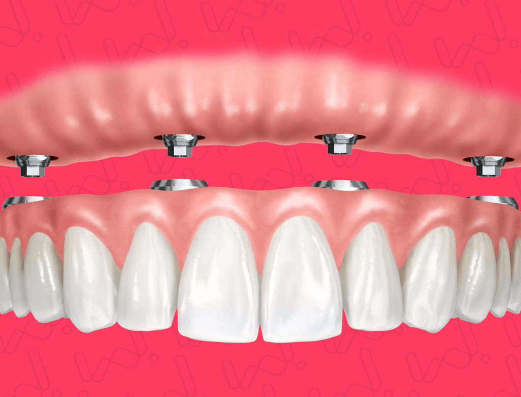 Dentadura(1)