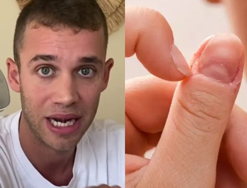 Influenciador Quase Morre Após Roer Unhas E Contrair Bactéria Fatal (foto Reprodução Redes Sociais)