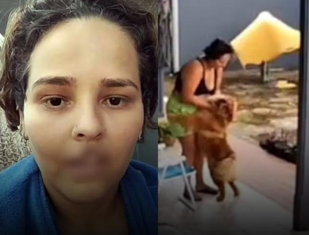 Mulher Tem Lábio Arrancado Por Cão De Estimação E Caso Termina Em Eutanásia (foto Reprodução Redes Sociais)