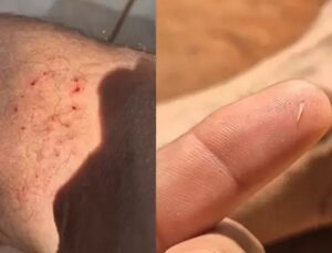 Dente de cobra fica preso na pele de influenciador após mordida rara; veja VÍDEO