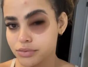 Mosca atinge olho de enfermeira e causa inchaço grave: “Tive medo de perder a visão”; veja VÍDEO