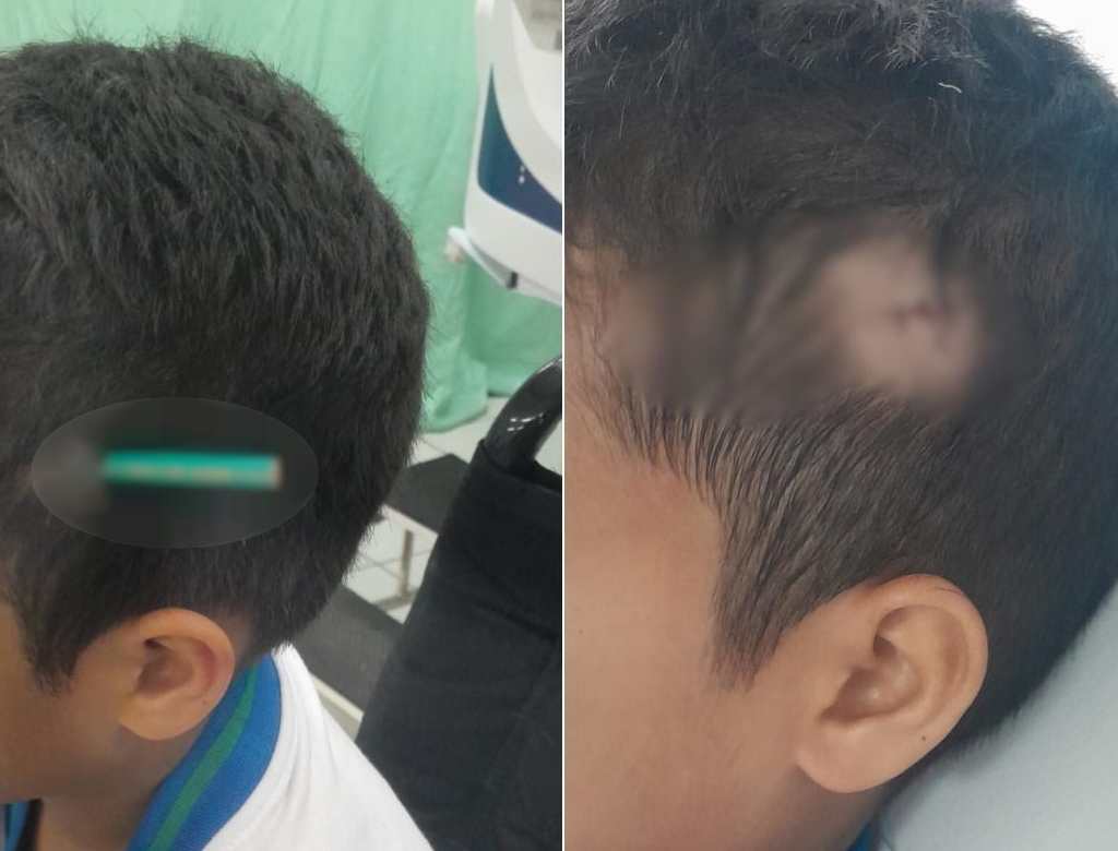 Tragédia em escola: menino de 9 anos crava lápis na cabeça do amigo; VEJA VÍDEO