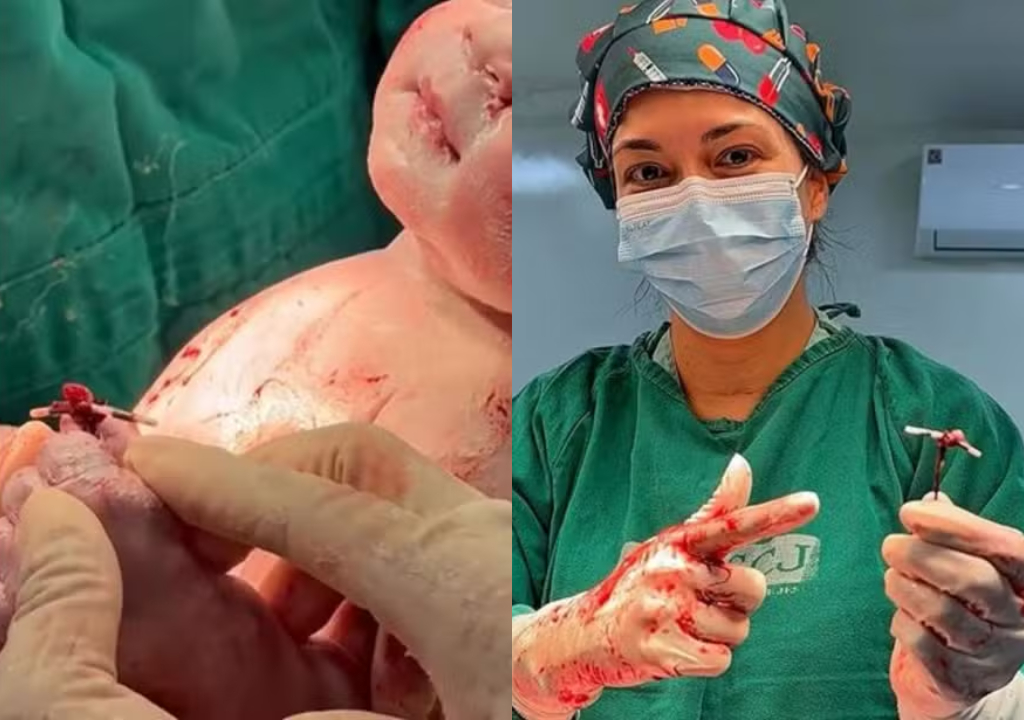 Bebê nasce segurando DIU (Foto: Reprodução)