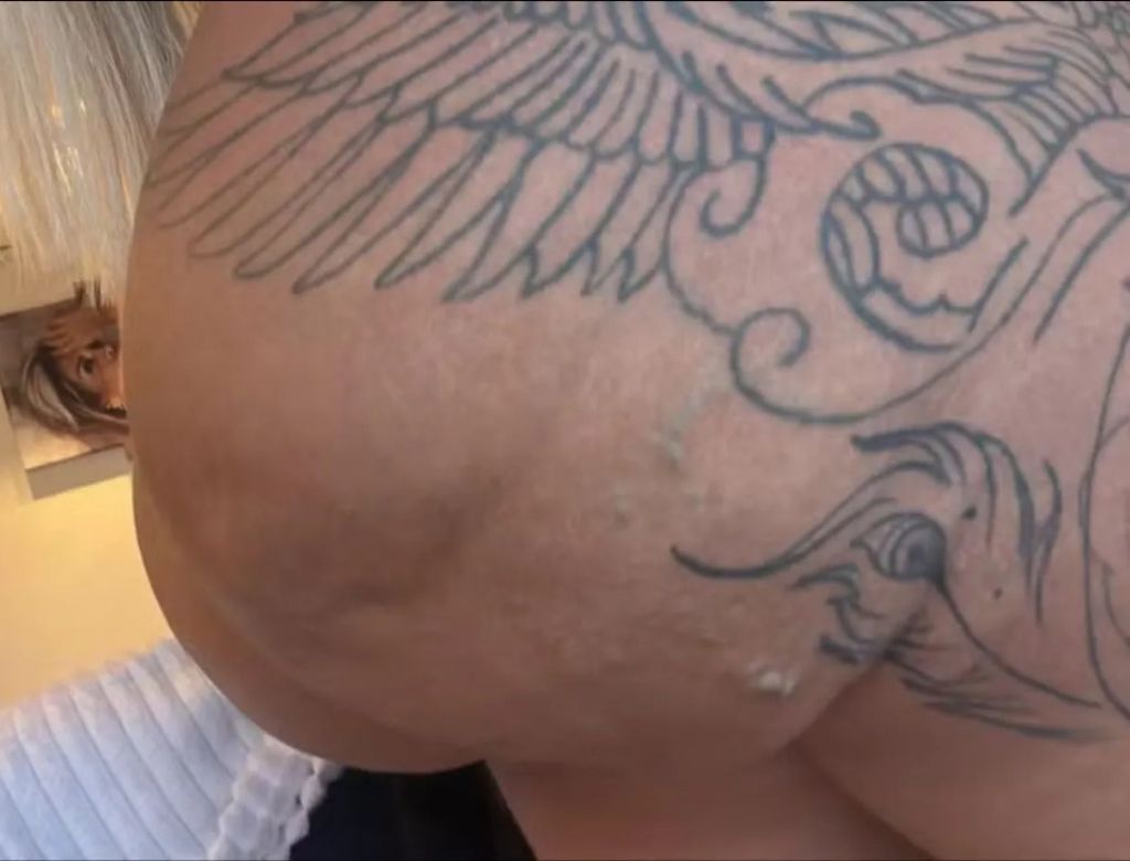 Juju Ferrari após aplicação de hidrogel (Reprodução: Redes Sociais)