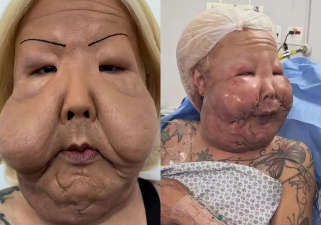 Médico exibe óleo mineral removido do rosto de Juju do Pix durante cirurgia; veja imagem