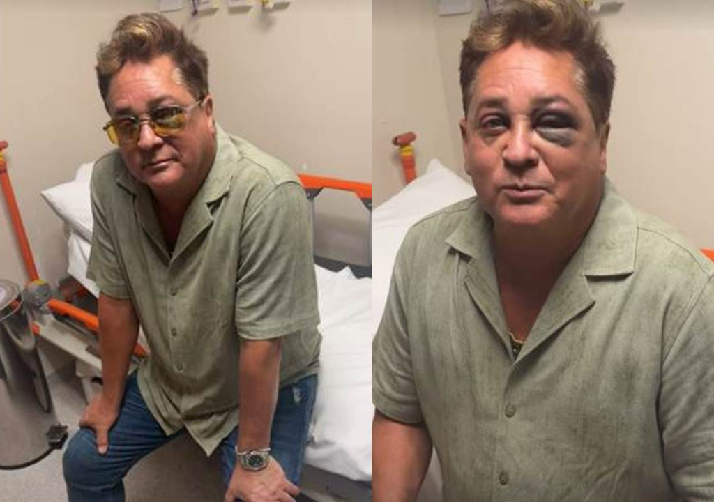 Leonardo confessa o que causou tombo que o deixou de olho roxo; veja