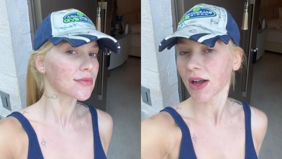 Virginia surge com rosto vermelho e explica o que causou; veja imagens
