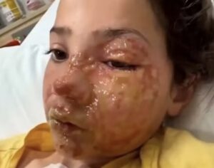 Menina de 10 anos fica com queimaduras no rosto após participar de desafio viral; saiba tudo!