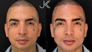 MC Guime faz harmonização facial na JK Estética Avançada com Dr Karim; VEJA!