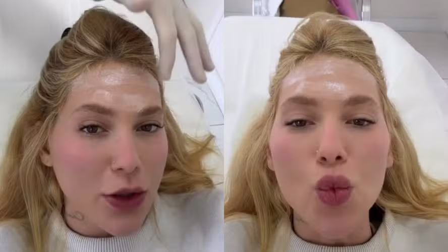 Virginia Fonseca revela 31 agulhadas de botox para tratar enxaqueca; saiba como funciona