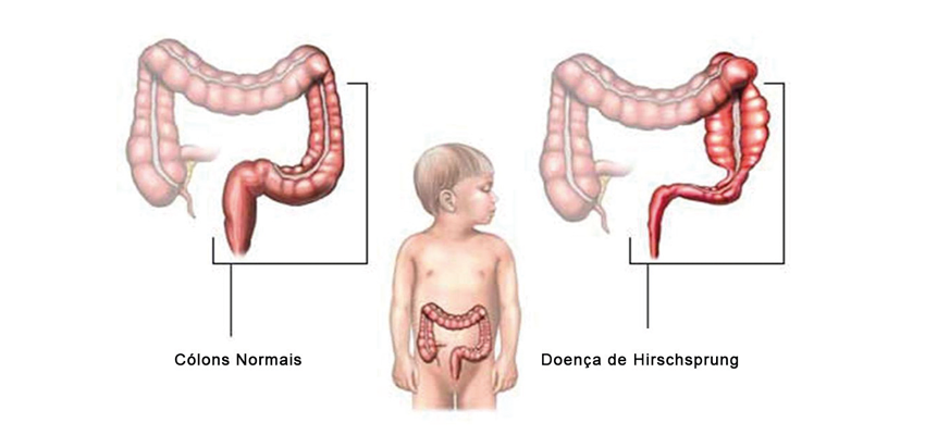 Doenca De Hirschsprung Megacolon Congenito 13082020211943