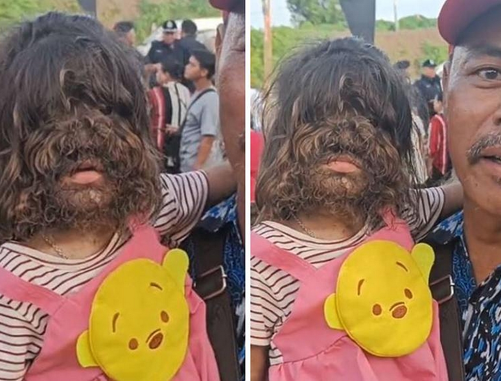 Síndrome Do Lobisomen (foto Reprodução Redes Sociais) 1