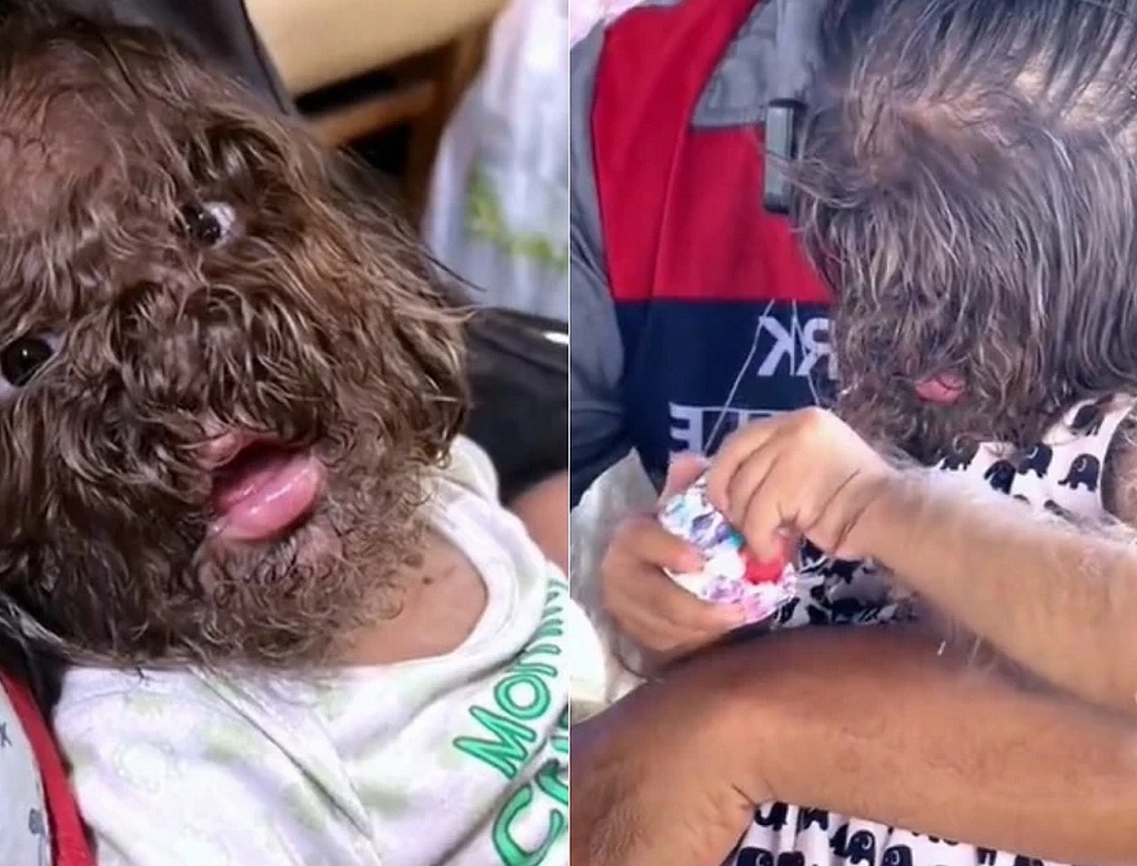 Síndrome Do Lobisomen (foto Reprodução Redes Sociais) 2