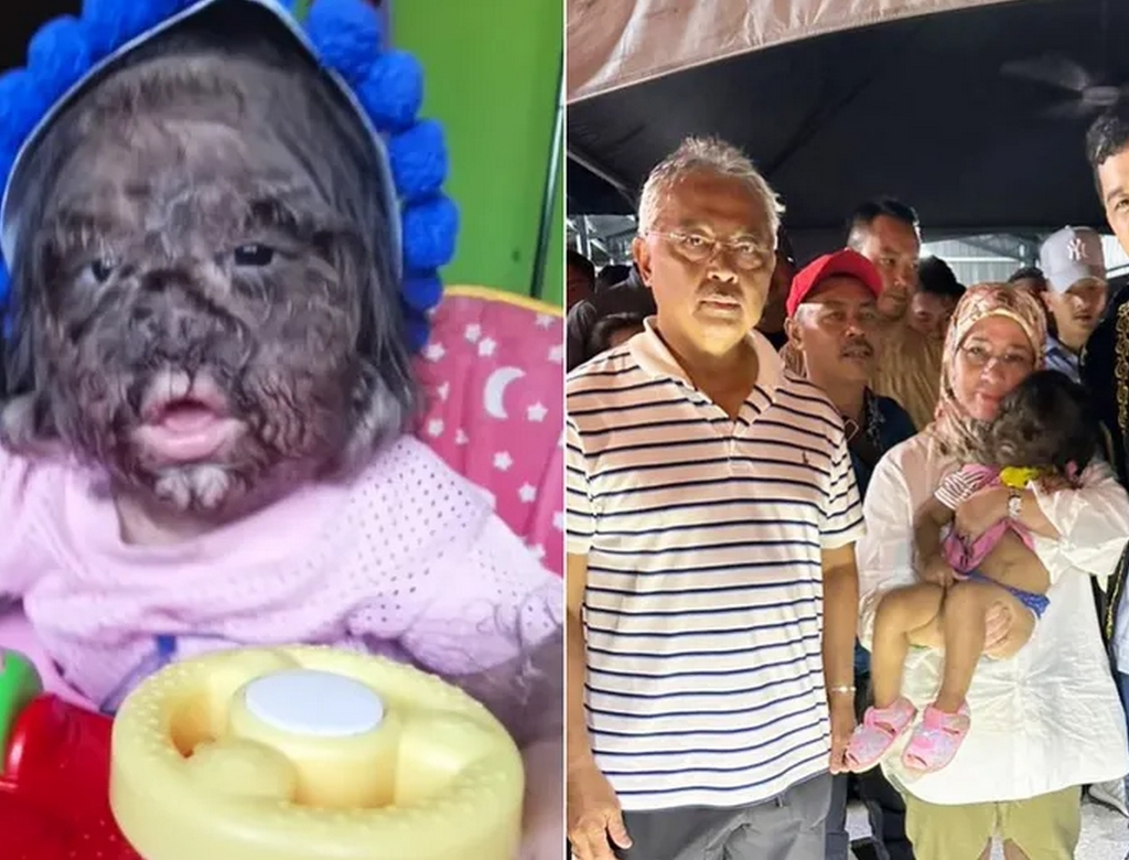 Síndrome Do Lobisomen (foto Reprodução Redes Sociais) 3