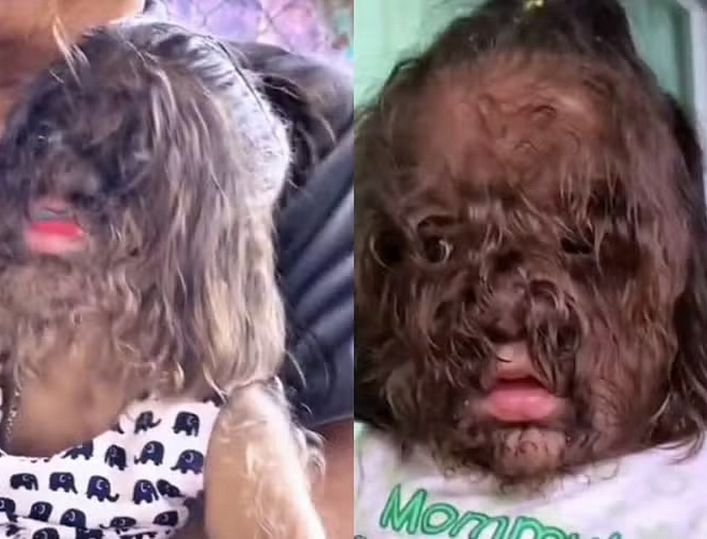 Síndrome Do Lobisomen (foto Reprodução Redes Sociais)