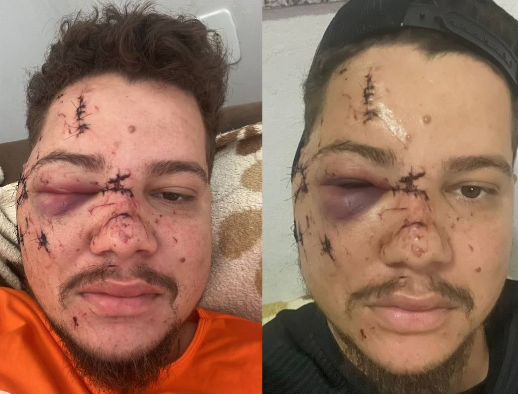 Cantor Sertanejo Fica Com Rosto Desfigurado Após Ser Agredido (foto Reprodução Redes Sociais)