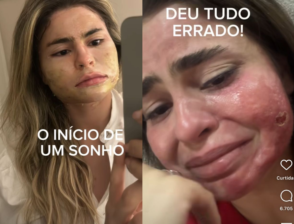 Médica desenvolve lesões no rosto após procedimento estético (Foto Reprodução Redes Sociais)
