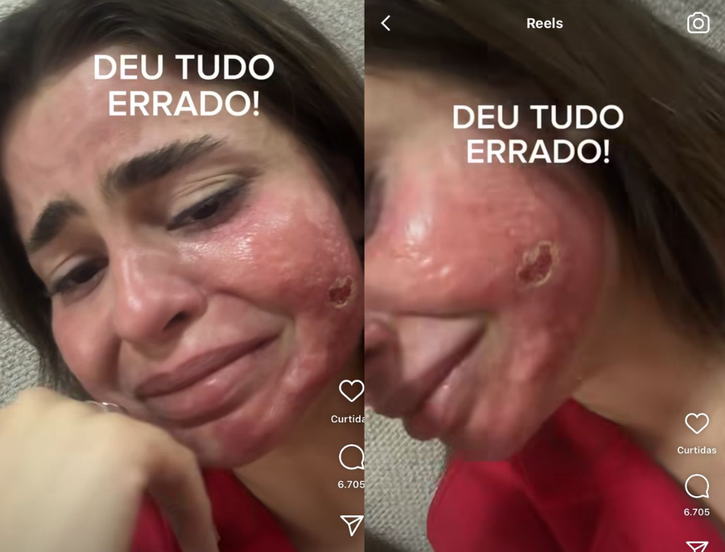 Médica Desenvolve Lesões No Rosto Após Procedimento Estético (foto Reprodução Redes Sociais)