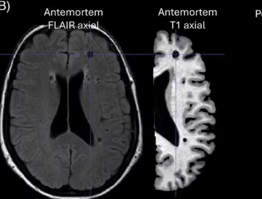 Caso Raro De Paciente Com Alzheimer E Sem Sinais De Demência Desafia Médicos (foto Reprodução Redes Sociais)