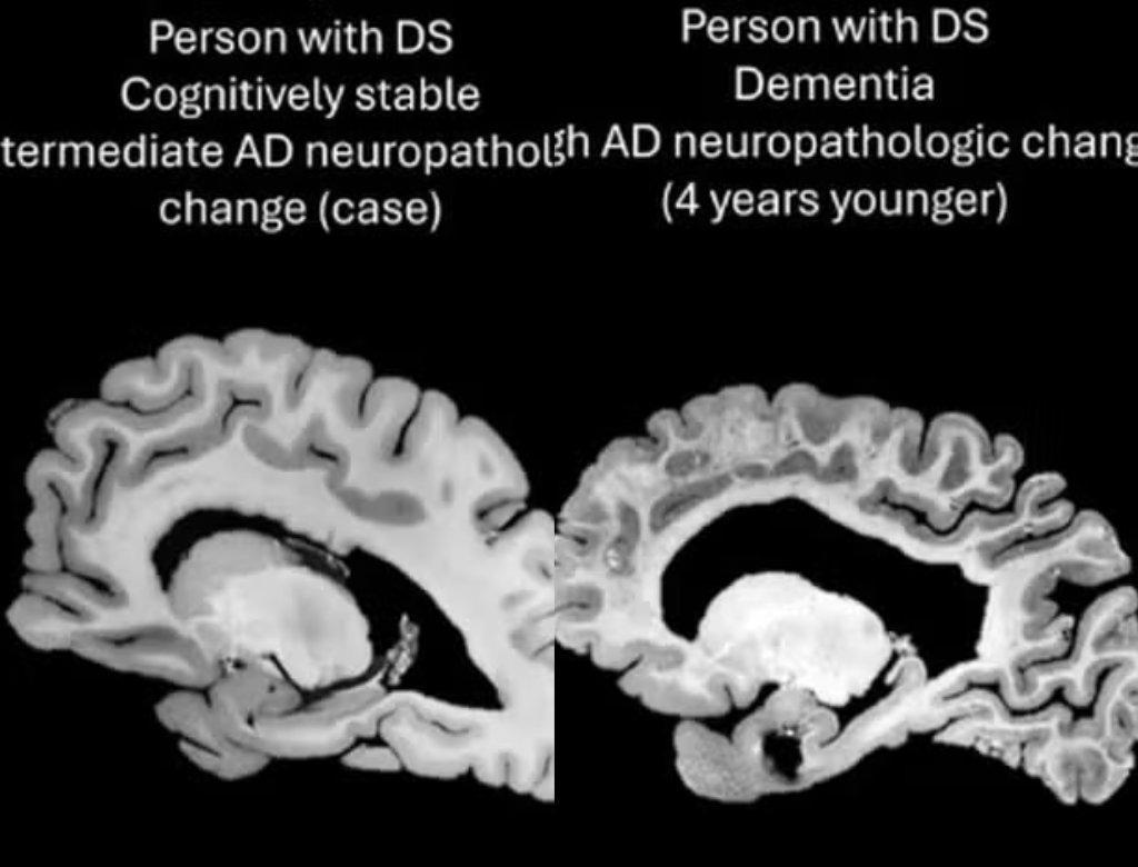 Caso raro de paciente com Alzheimer e sem sinais de demência desafia médicos (Foto Reprodução Redes Sociais)