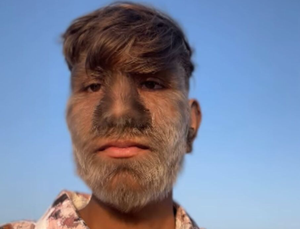 Síndrome do lobisomem (Foto Reprodução Redes Sociais)