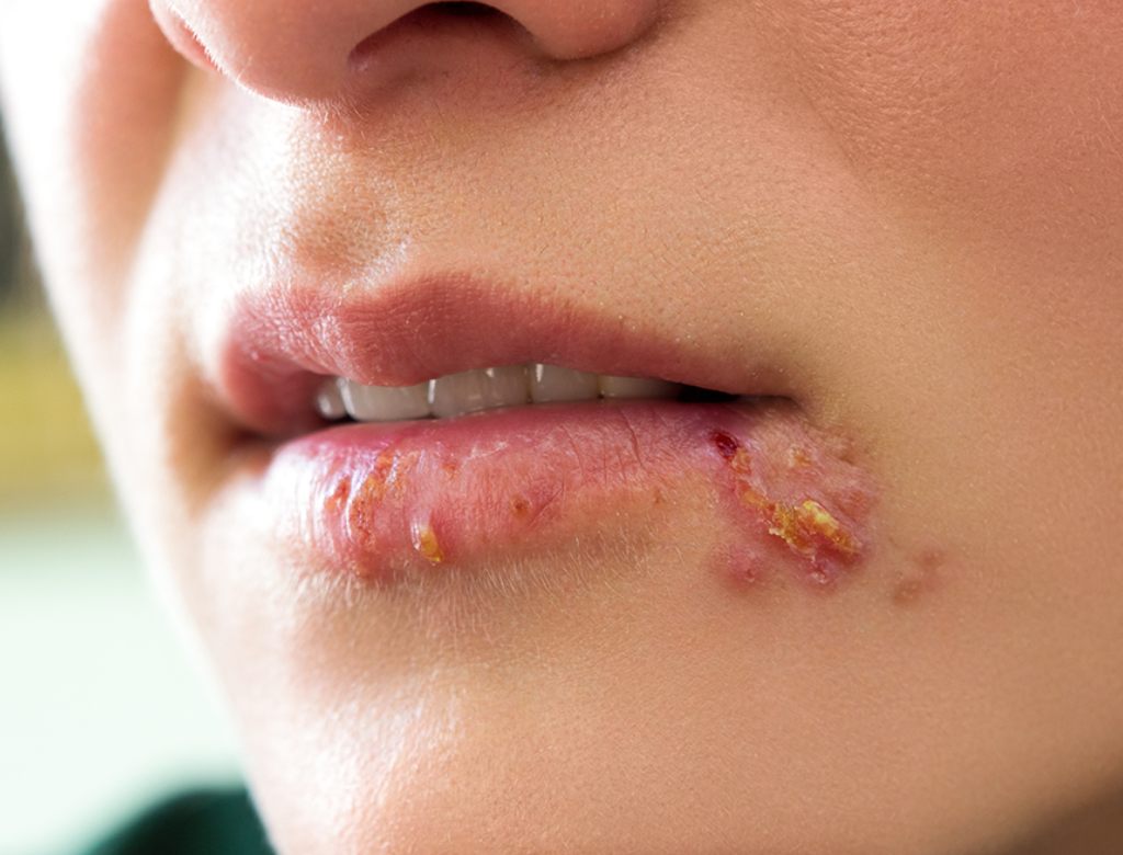 vírus herpes (Foto Reprodução Redes Sociais)