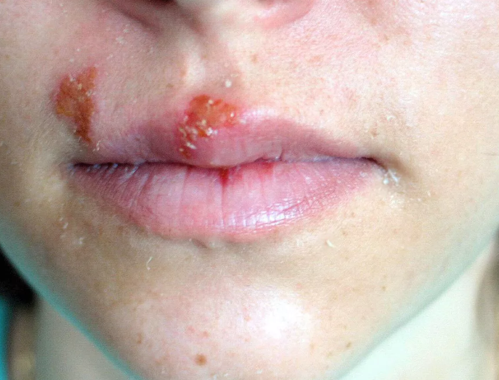 Vírus Herpes (foto Reprodução Redes Sociais)