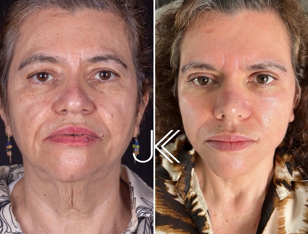 Antes E Depois (foto Reprodução Redes Sociais) 3