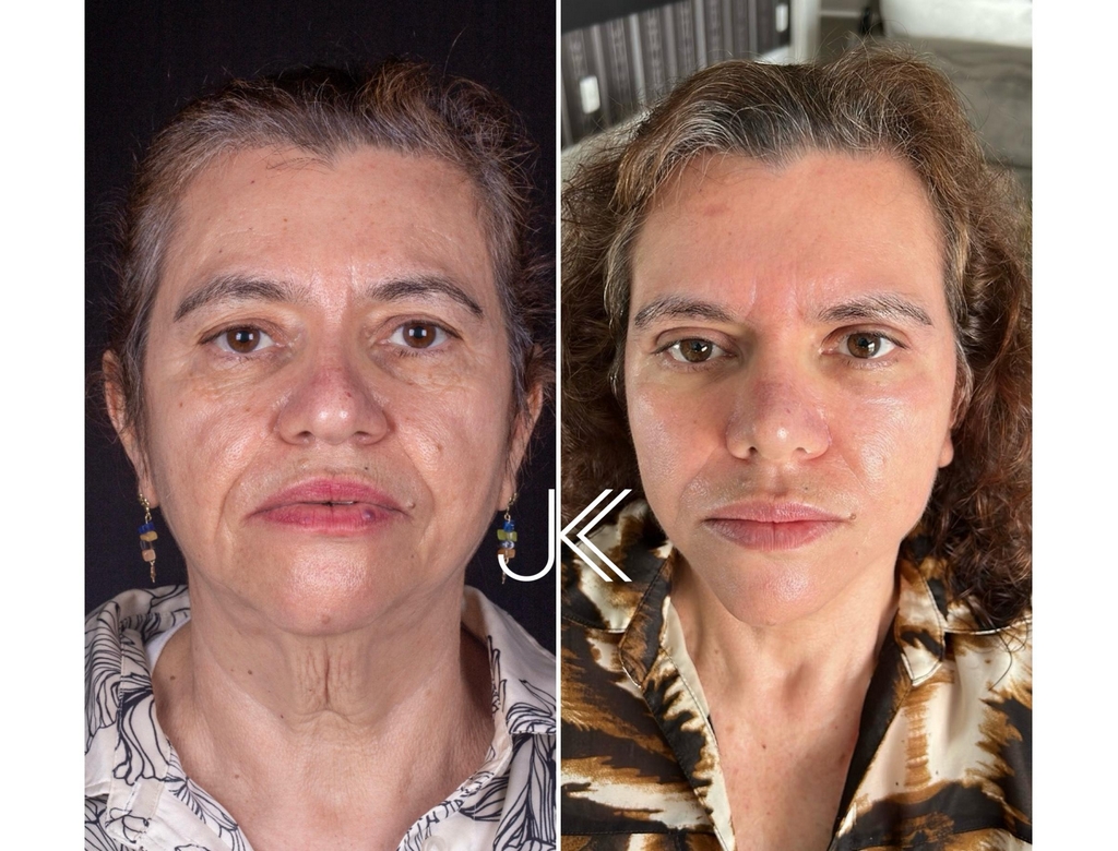 Antes e Depois (foto Reprodução Redes Sociais)