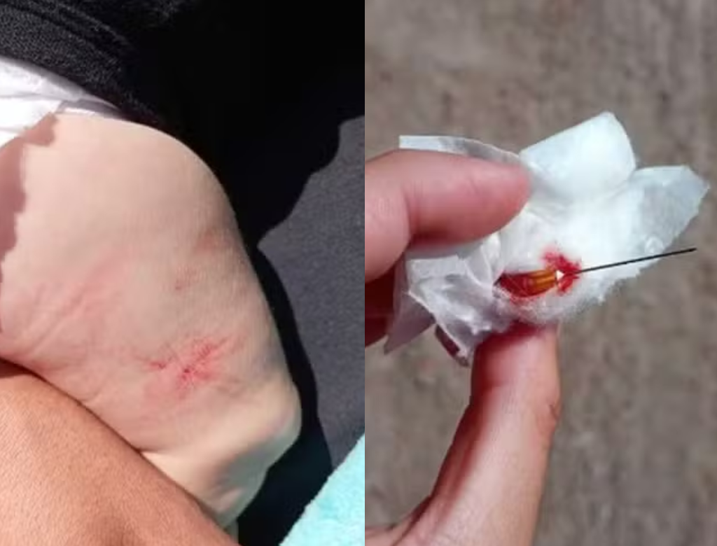 Enfermeiro esquece agulha em perna de bebê de 4 meses (Foto Reprodução Redes Sociais)
