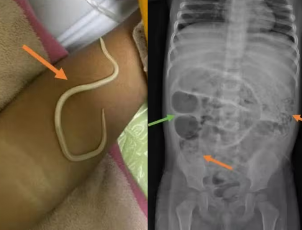 Menino é Internado Com Inchaço Abdominal E Médicos Descobrem Dezenas De Vermes (foto Reprodução Redes Sociais)