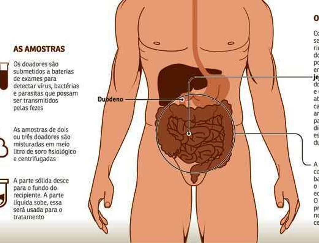 Transplante(1)