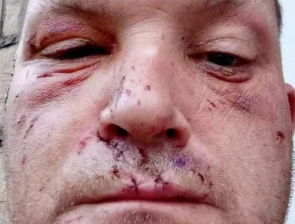 Homem tem orelha arrancada por cachorro enquanto dormia (Foto Reprodução Redes Sociais)