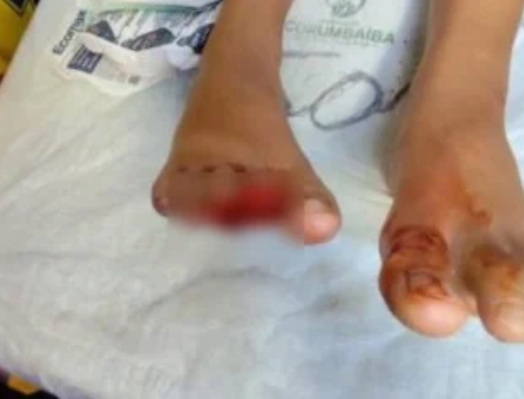 Criança de 9 anos tem dedos arrancados por piranha em Goiás (Foto Reprodução Redes Sociais)